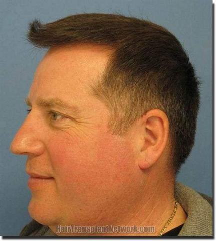 Hair restoration procedure results