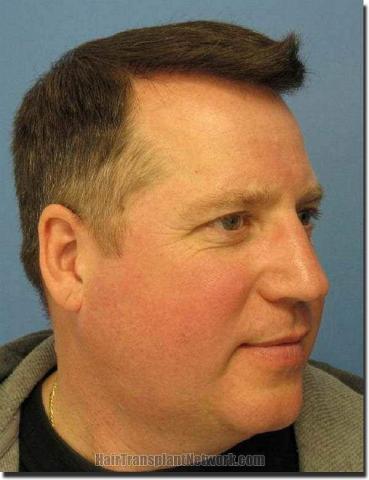 Hair restoration procedure results