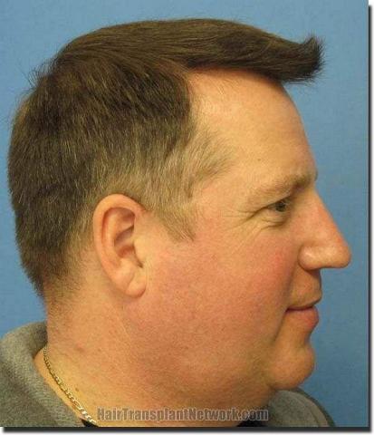 Hair restoration procedure results