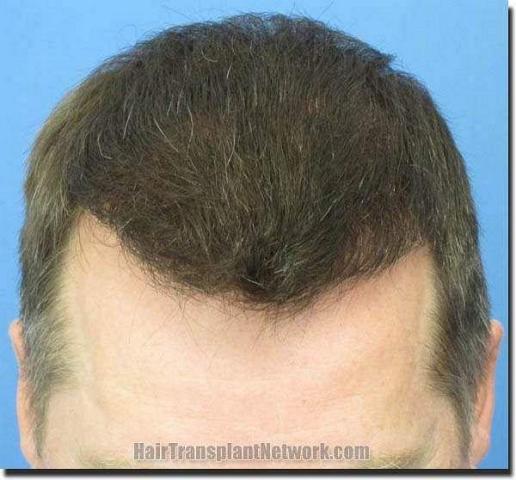 Hair restoration procedure results