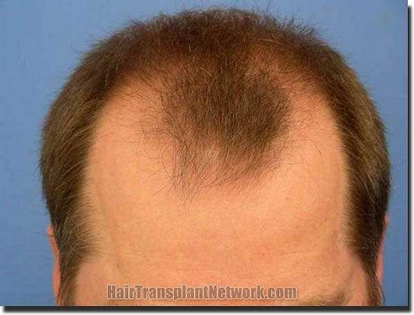 Hair restoration procedure results