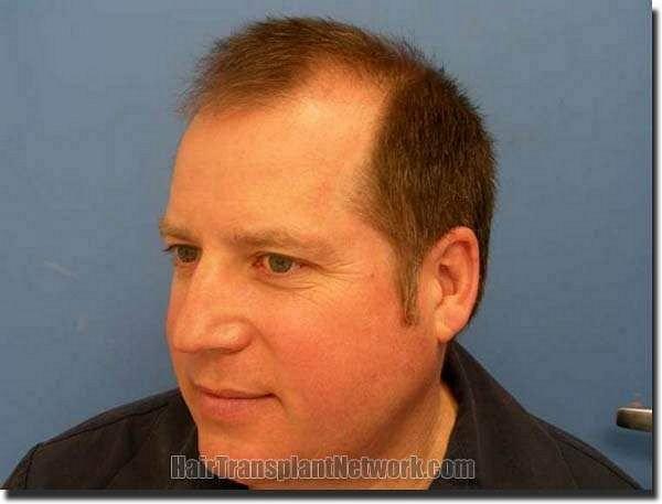 Hair restoration procedure results