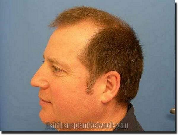 Hair restoration procedure results