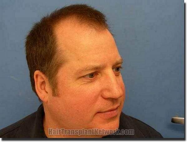 Hair restoration procedure results