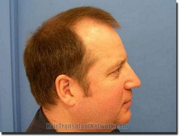 Hair restoration procedure results