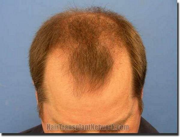 Hair restoration procedure results