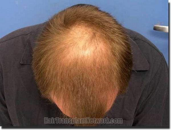 Hair restoration procedure results