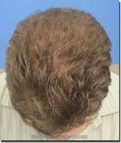 Hair restoration procedure results