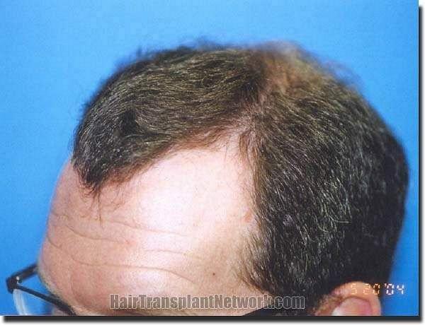 Hair restoration procedure results