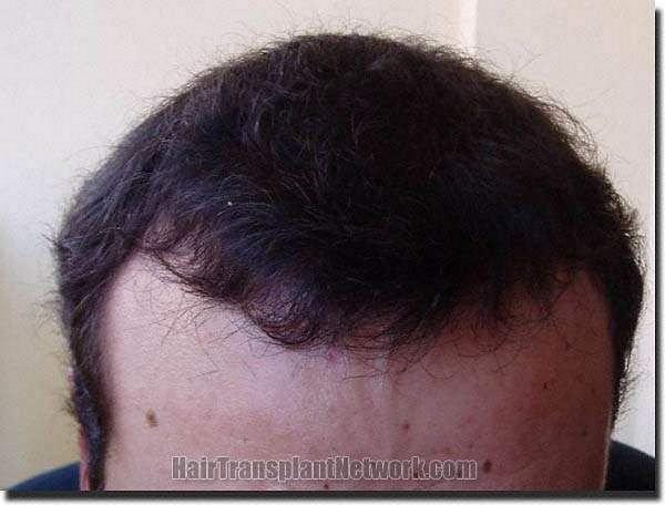 Hair restoration procedure results