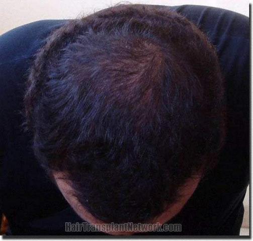 Hair restoration procedure results