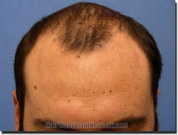 Hair restoration procedure results