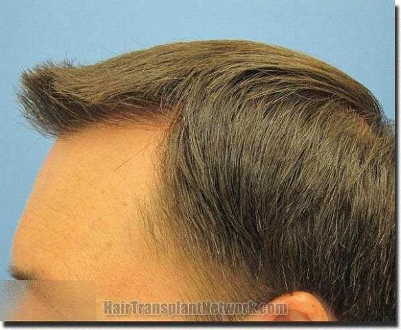 Hair restoration procedure results