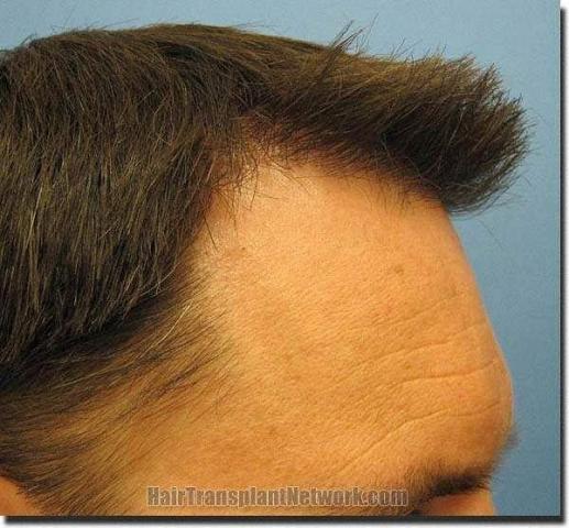 Hair restoration procedure results