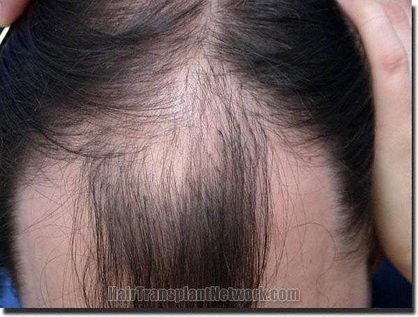 Hair restoration procedure results