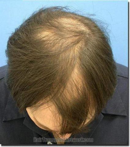 Hair restoration procedure results