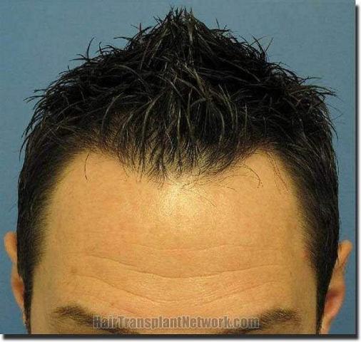 Hair restoration procedure results