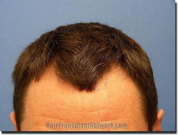 Hair restoration procedure results