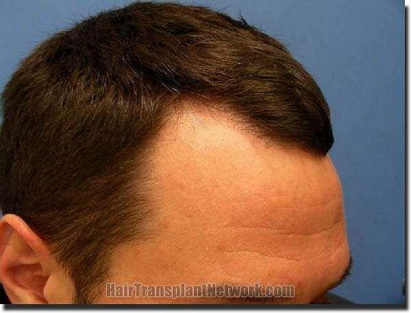 Hair restoration procedure results