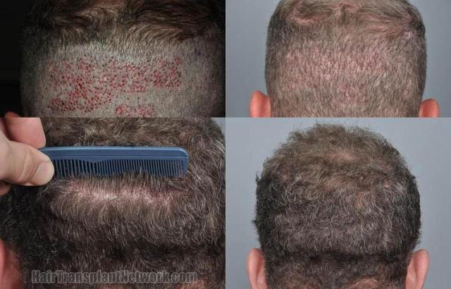 Hair restoration procedure before and after pictures