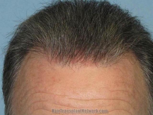 Hair restoration surgery before and after photos