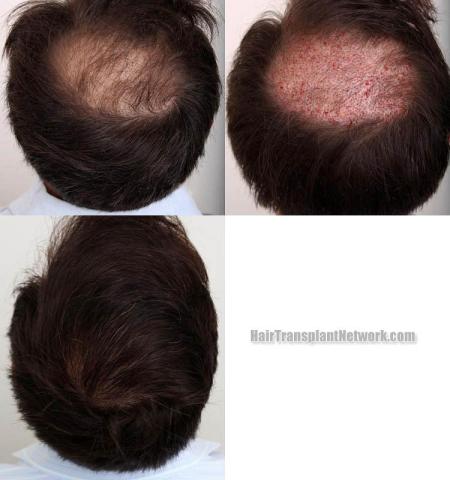 Hair transplantation surgery before and after pictures