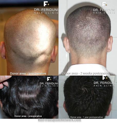 Hair restoration procedure before and after pictures