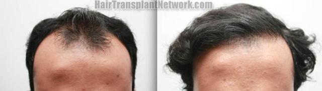 Hair restoration procedure before and after results