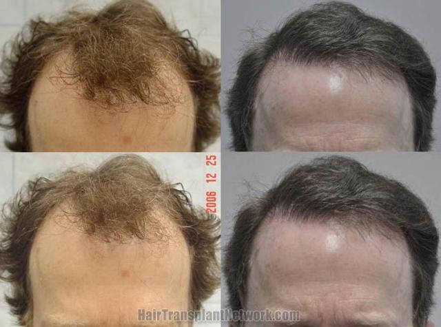 Hair transplantation surgery before and after images