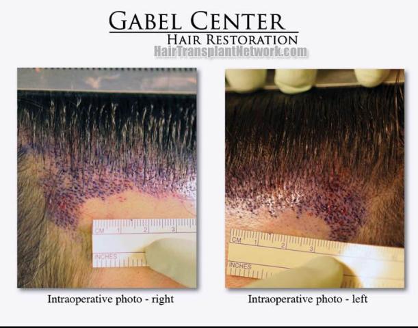 Hair restoration surgery before and after photos