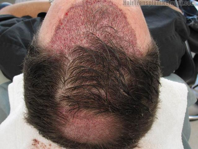 Hair restoration surgery before and after images