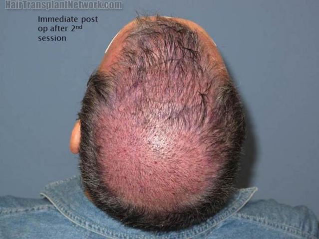 Hair restoration procedure before and after pictures