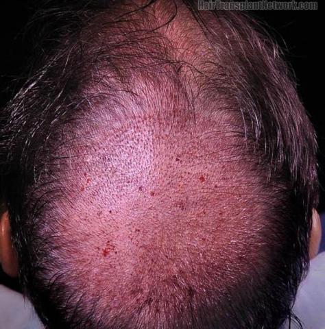 Hair restoration surgery before and after photos