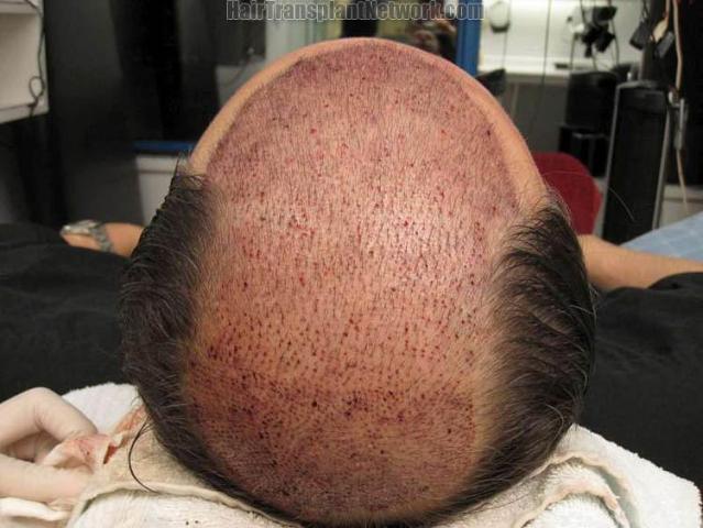 Hair restoration surgery before and after photos