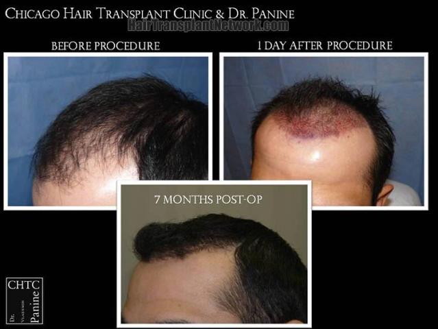 Hair transplantation surgery before and after pictures