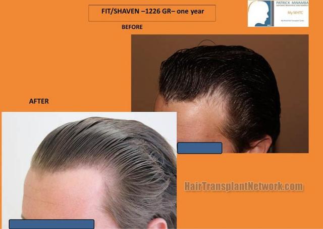 Hair transplantation surgery before and after pictures