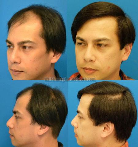 Hair transplantation surgery before and after pictures