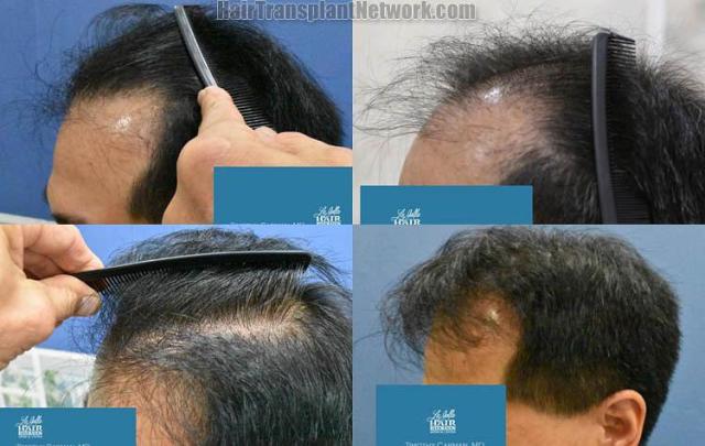 Hair transplantation surgery before and after photos