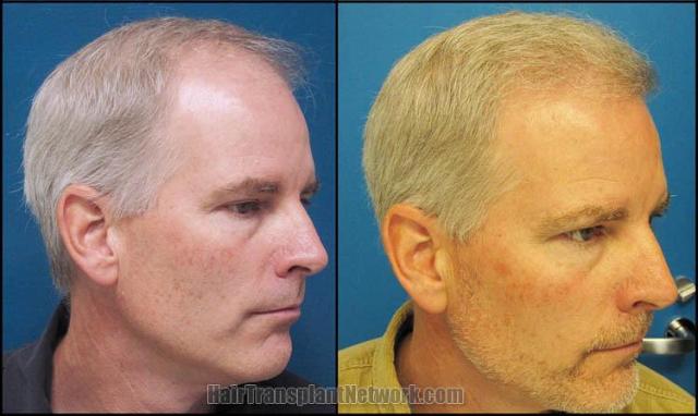 Hair transplantation surgery before and after pictures