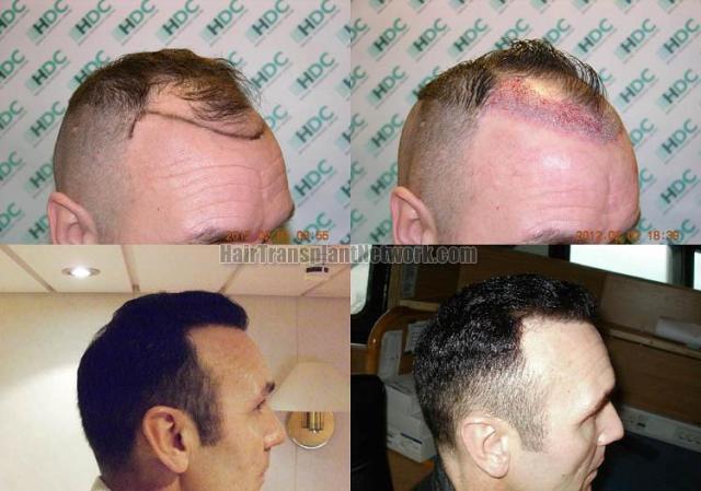 Hair transplantation surgery before and after images