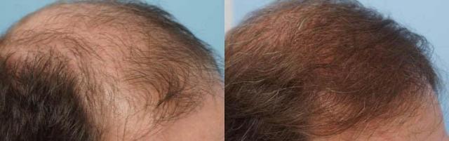 Hair restoration procedure before and after pictures