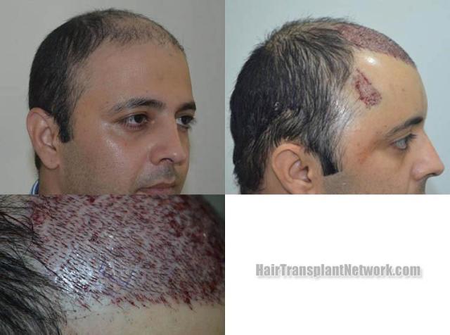 Hair transplantation surgery before and after photos