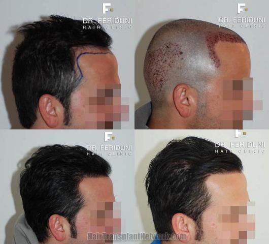 Hair transplantation surgery before and after photos