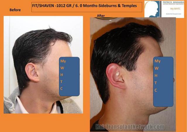 Hair transplantation surgery before and after pictures