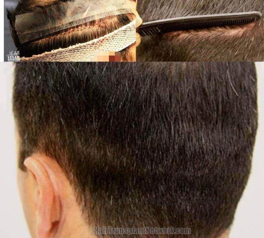 Hair restoration procedure before and after pictures