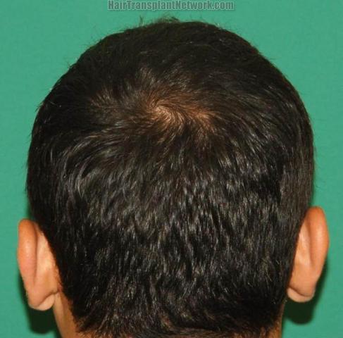 Hair transplantation surgery before and after images