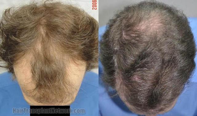 Hair restoration procedure before and after results