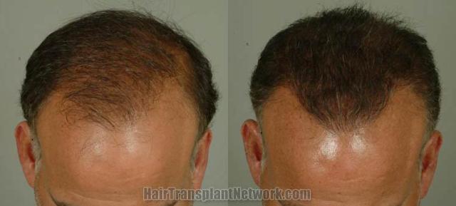 Hair restoration surgery before and after images