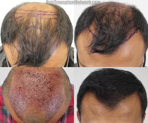 Hair restoration procedure before and after results