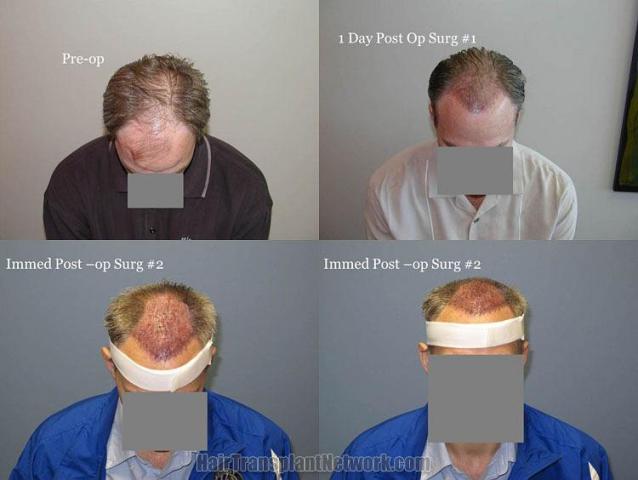 Hair transplantation surgery before and after images